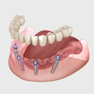All-On-4 Dental Implants East Dulwich Treatment Consultations Now Open at The Gardens Dental Centre (Smile 4 U)